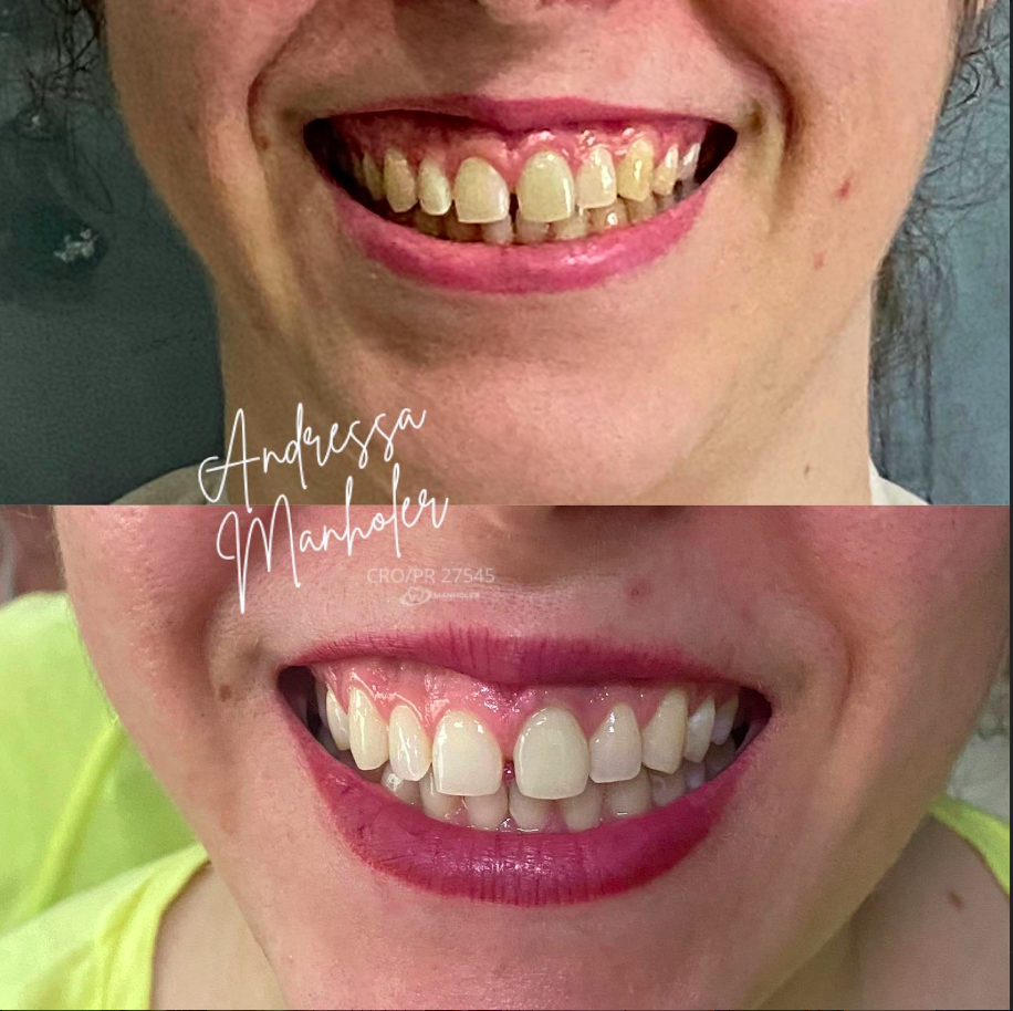 Clareamento Laser