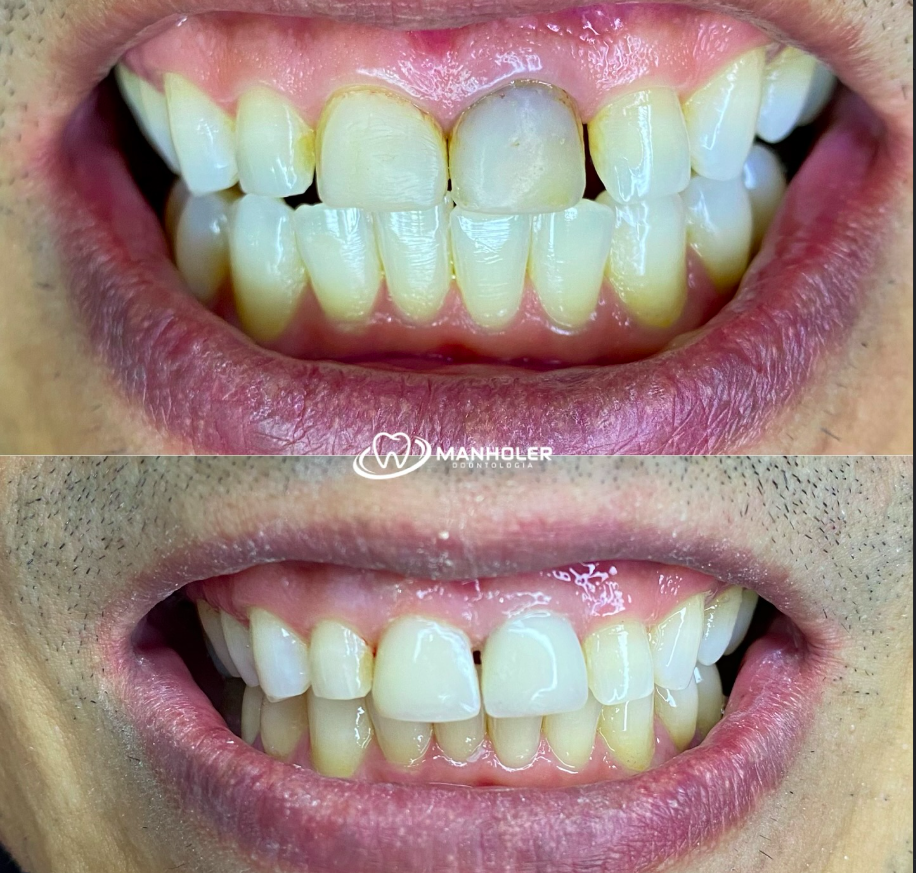 Transformação com Facetas