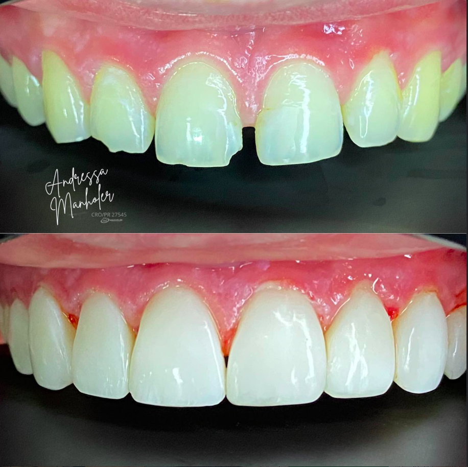 Estética com Facetas Direct