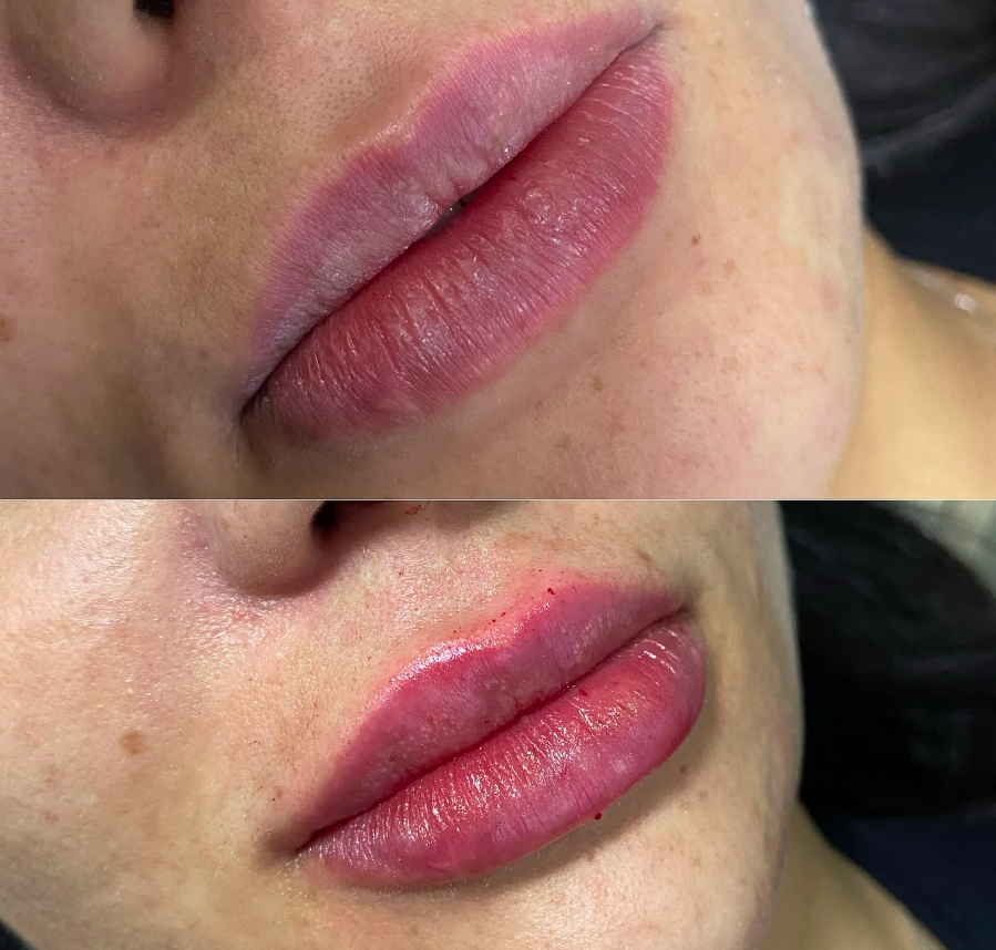 Preenchimento Labial