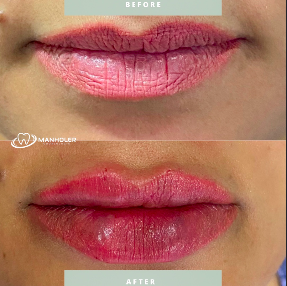 Preenchimento Facial Estético