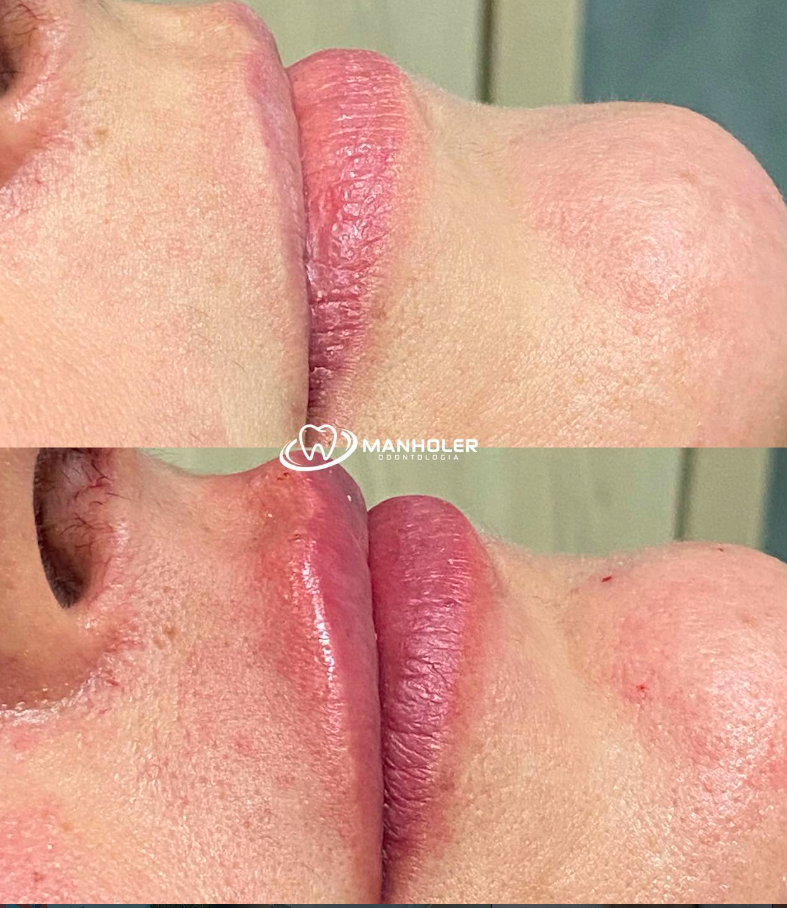 Escultura Labial Avançada