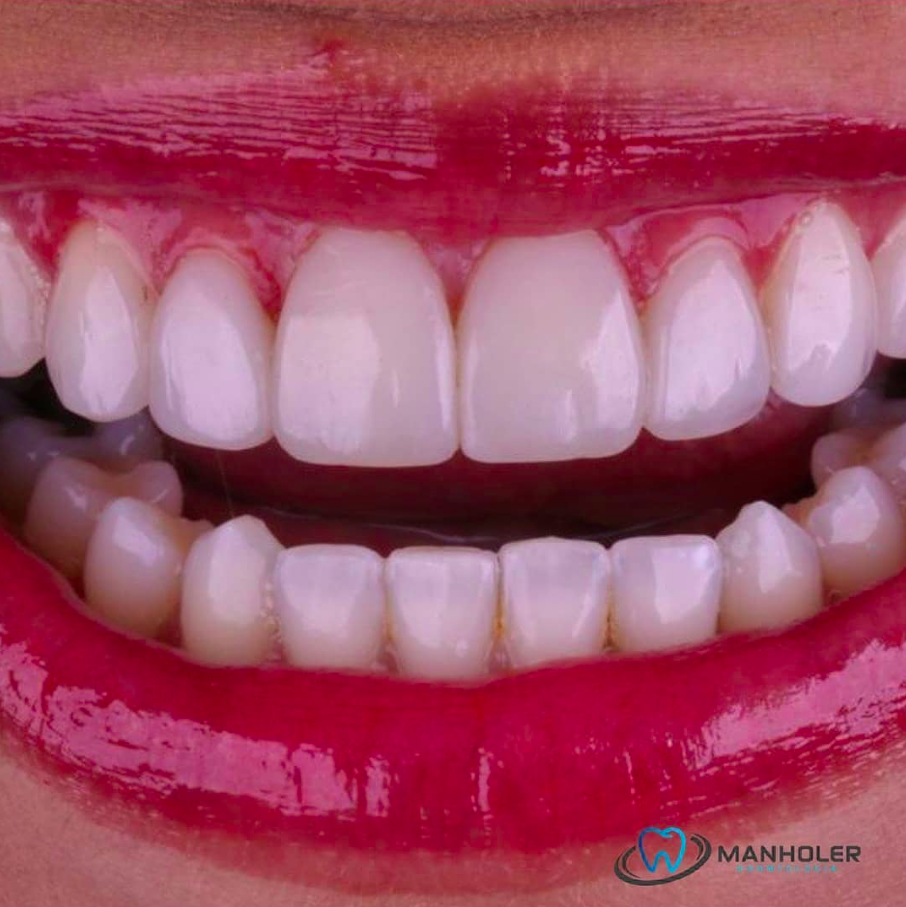 Reabilitação Estética Completa