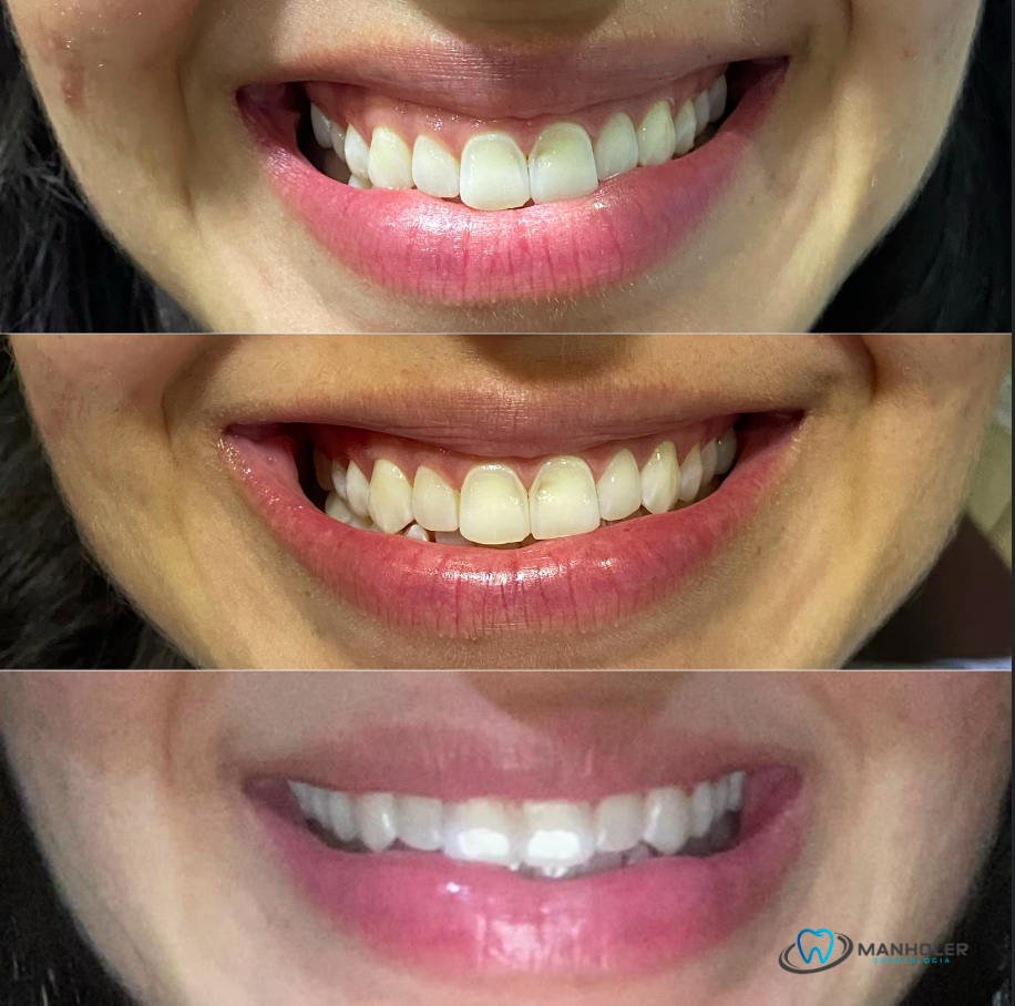Tratamento de Sorriso Gengival